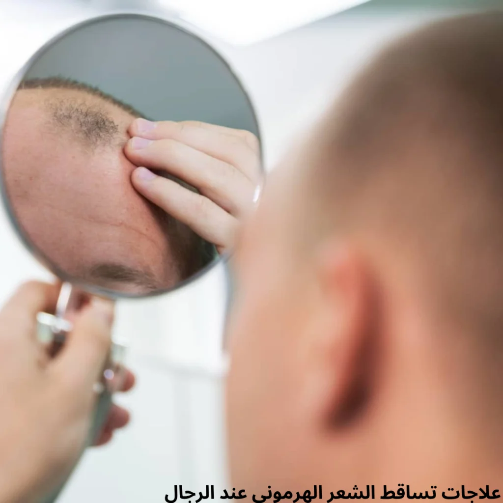 علاج تساقط الشعر الهرموني لدى الرجال