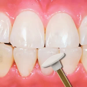 إزالة تقويم الأسنان